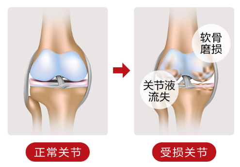 关节疼痛吃氨糖软骨素有效果吗？