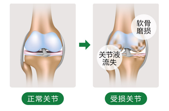 血糖高能吃氨糖软骨素钙片吗？