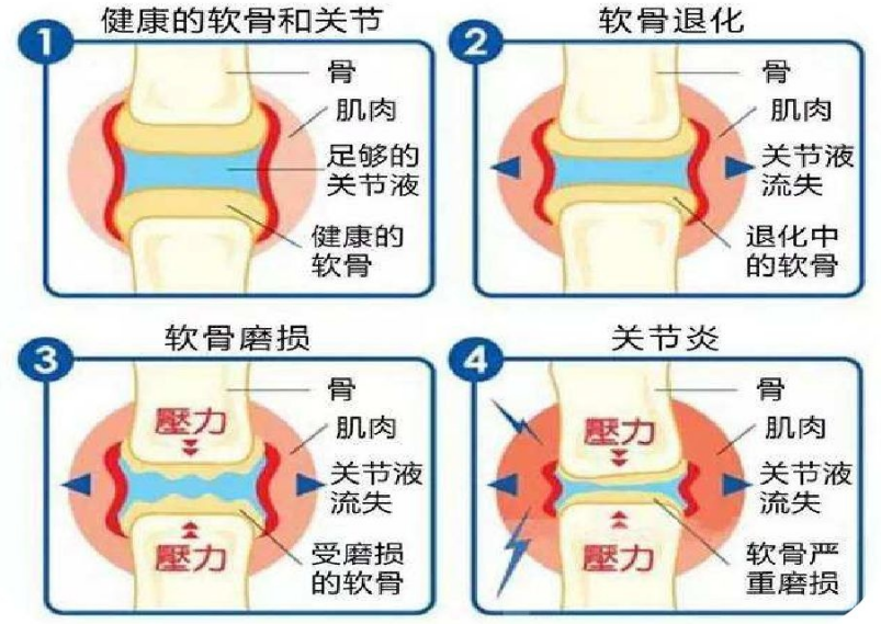 氨糖软骨素对关节炎有用吗?现在知道也不晚